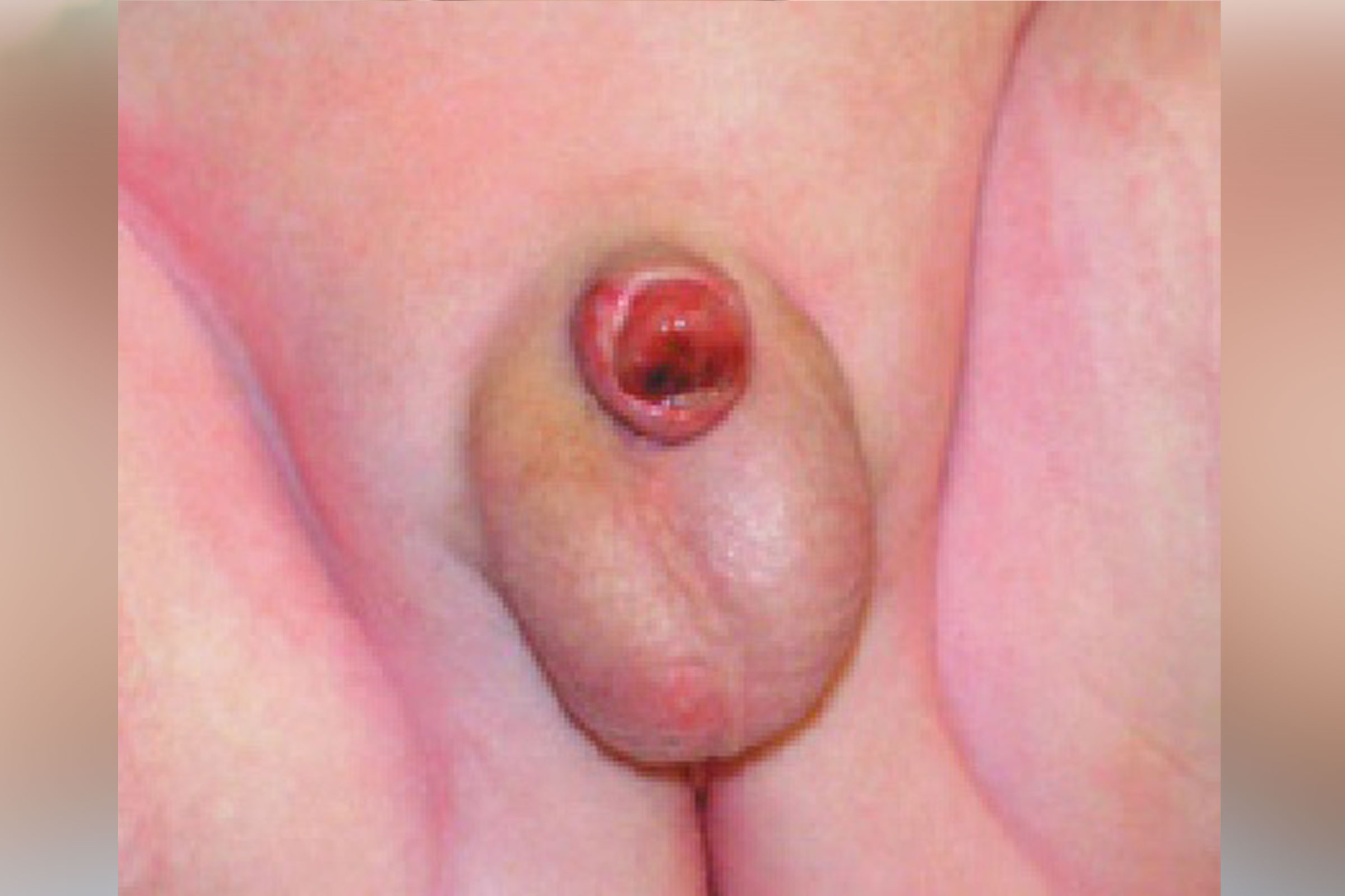 circumcision1_edited