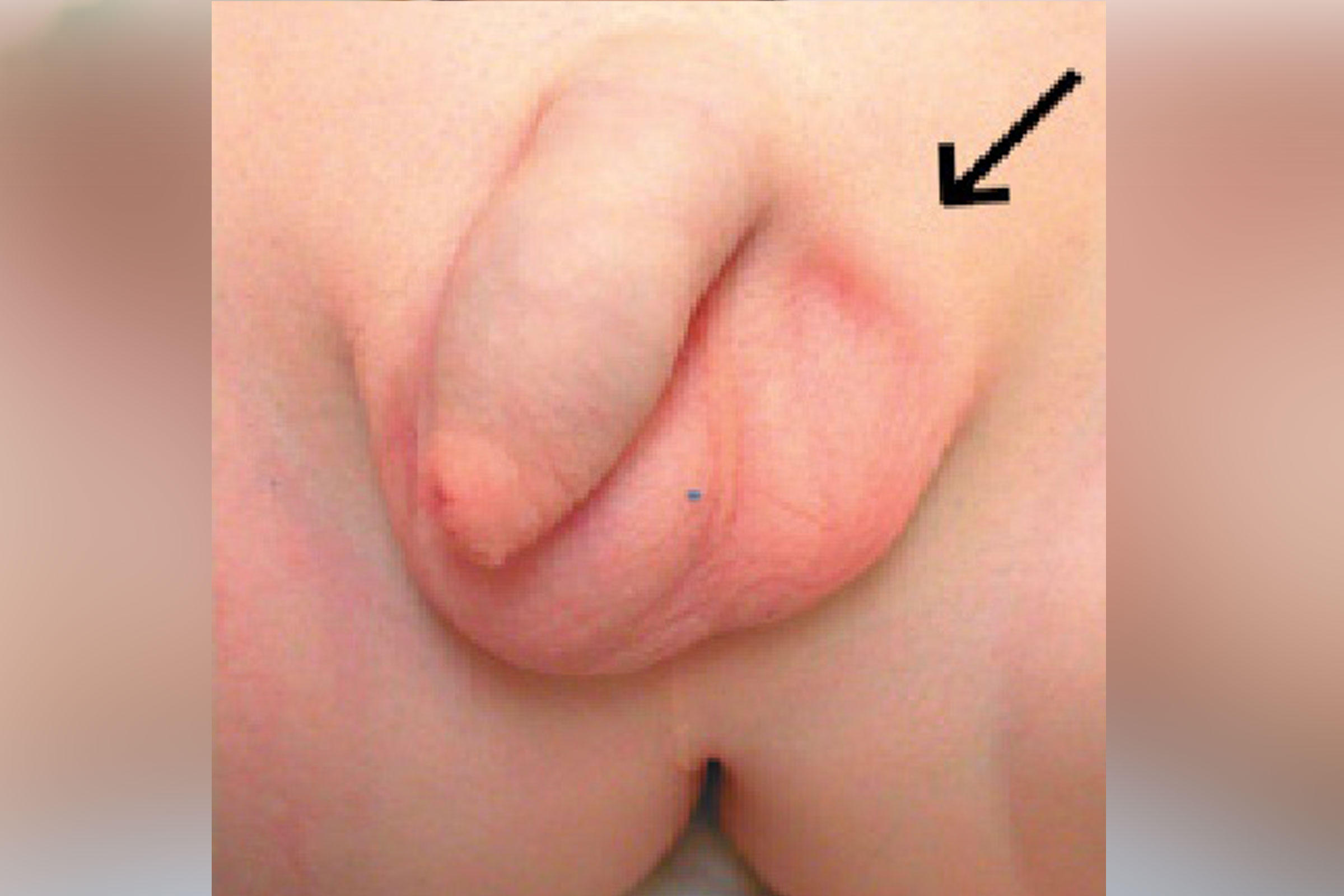 circumcision2_edited