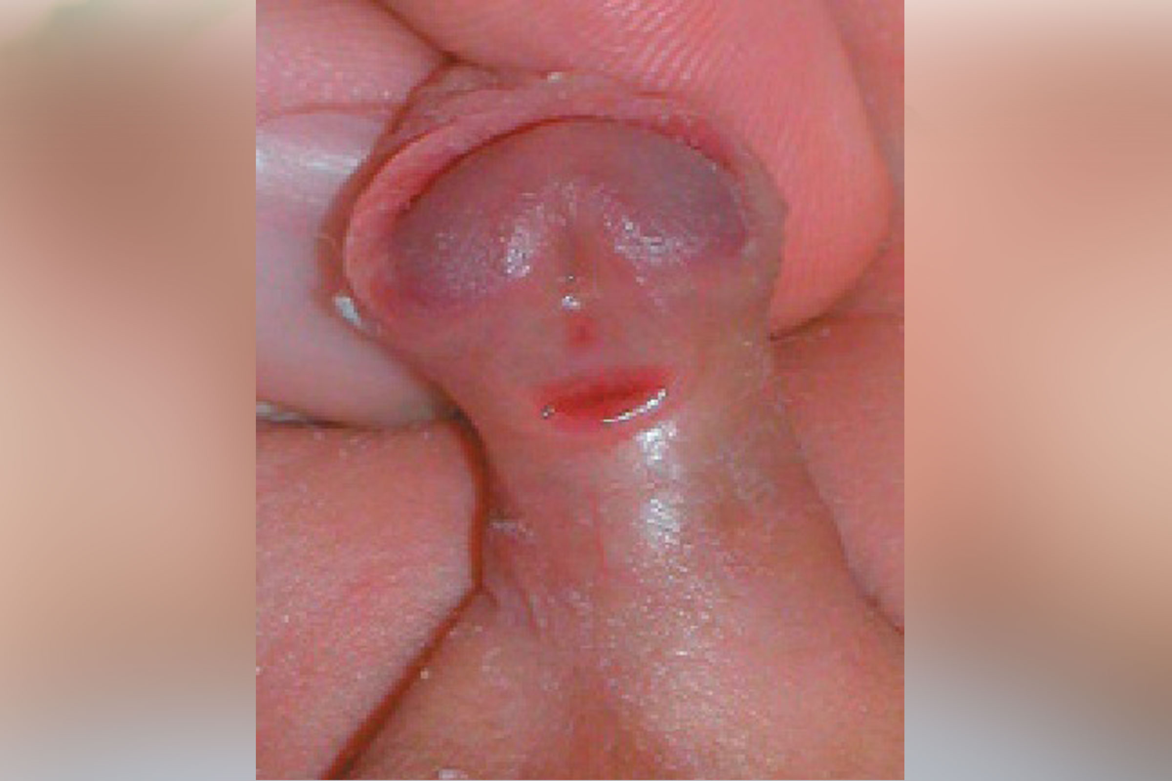 circumcision3_edited