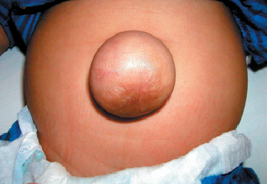 Umblical-epigastric-Hernias